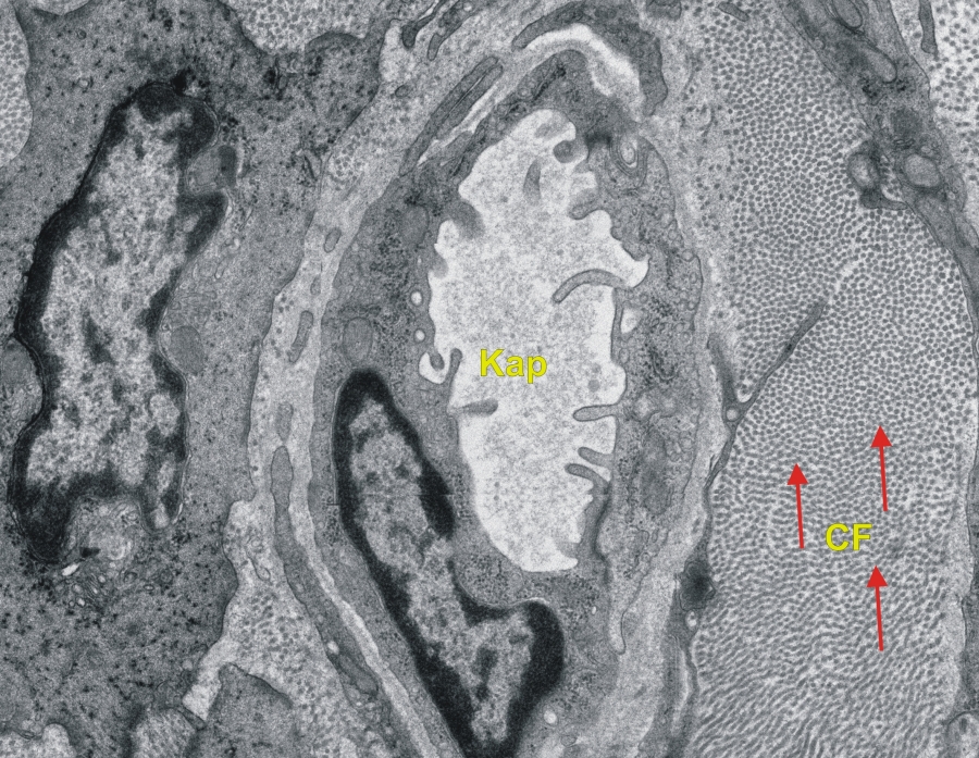 sűrű regenerált kötőszöveti regeneráció alagút szindróma torna
